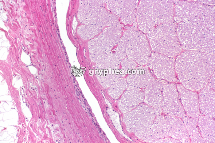 Nerf optique - vue partielle - CT x15 - gryphea.com